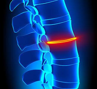 Bandscheibenvorfall und Rückenschmerzen als Illustration gezeigt