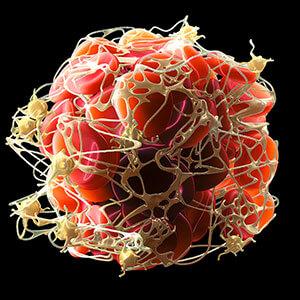 Untersuchung Blutbahnen und Gefäße bei Verdacht auf Thrombose — Diagnose der Radiologie