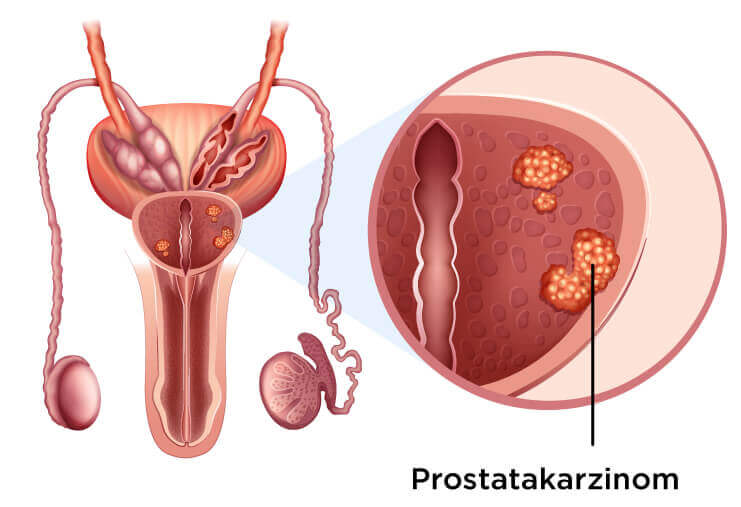 Ihre private Radiologie: Prostatakrebs Illustration